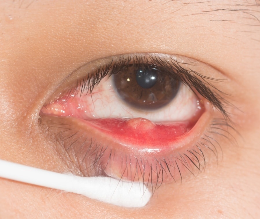 chalazion și vedere încețoșată efectul hipertensiunii arteriale asupra vederii